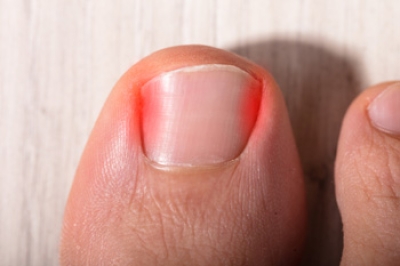 How to Manage an Ingrown Toenail